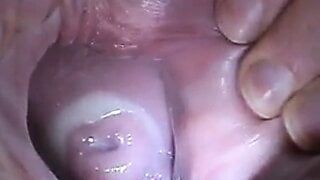 Insertion Semen Cum In Cervix Wide Stretching Pussy Speculum Ok Porn